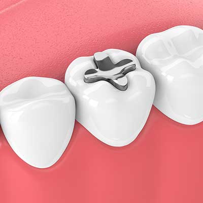 Dental Sealants