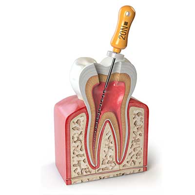 Root Canal Treatment