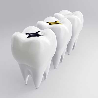 Dental Fillings