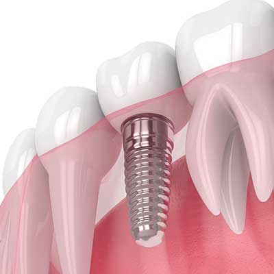 Dental Implants