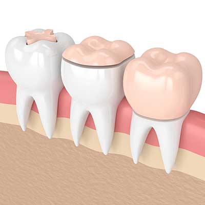 Dental Inlays and Onlays
