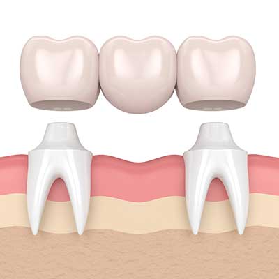 Dental Bridges